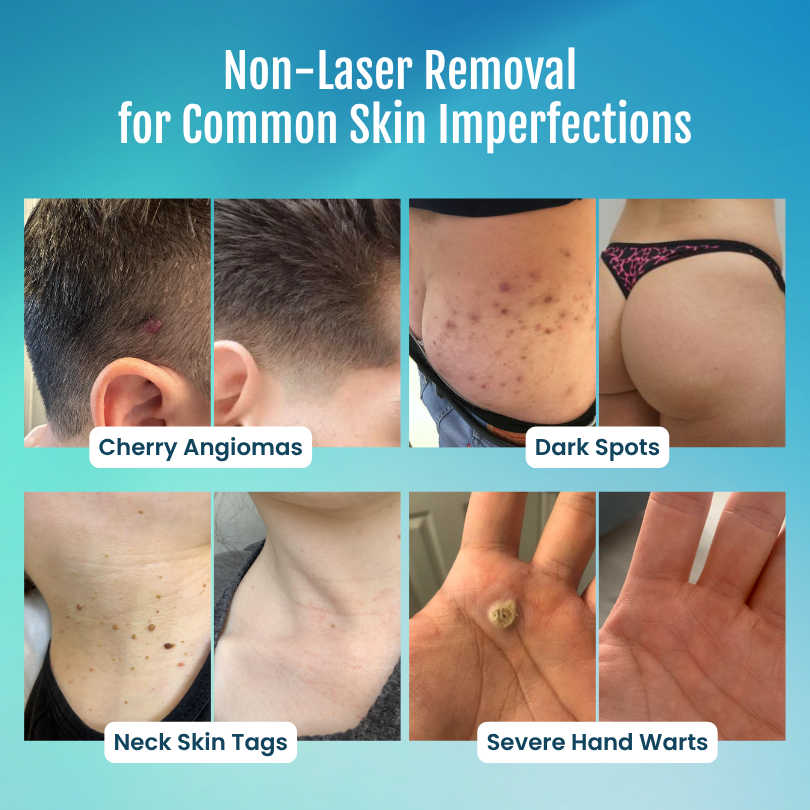 SpotlessPro® 7-Day Advanced Blemish & Tag Eraser